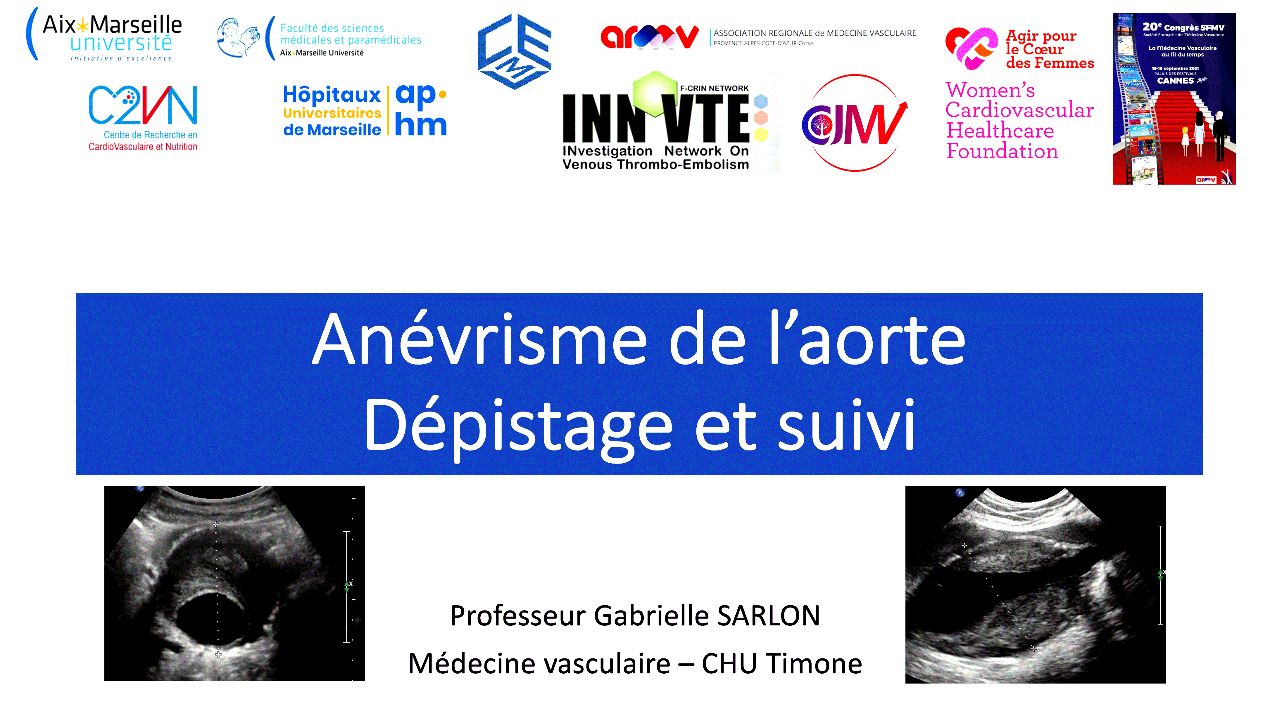 Pr SARLON - Anévrisme Aorte Abdominale - Médecine Vasculaire - Marseille