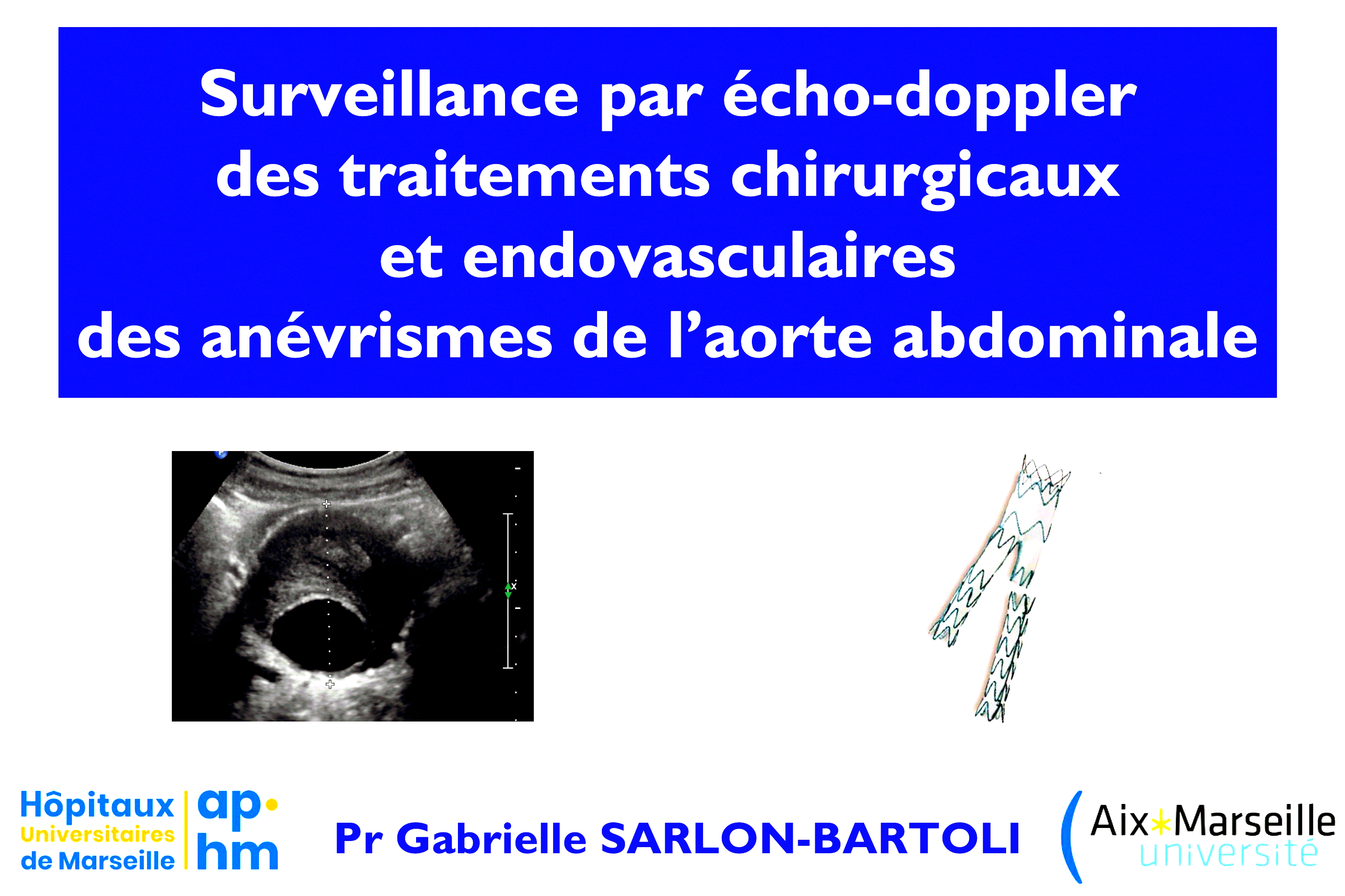 Pr SARLON - Suivi Anévrisme Aorte Abdominale - Médecine Vasculaire - Marseille