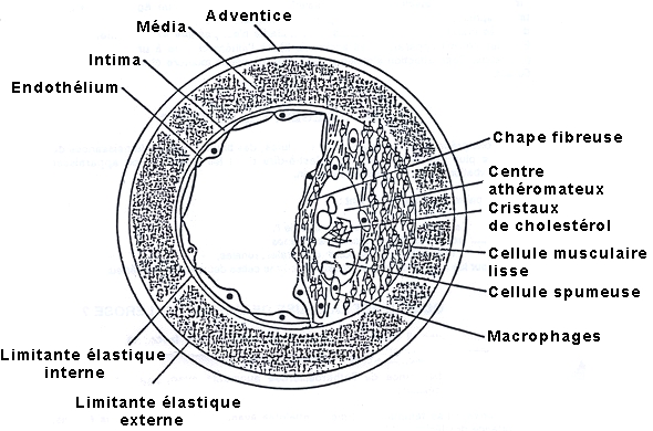 Plaque Atherome