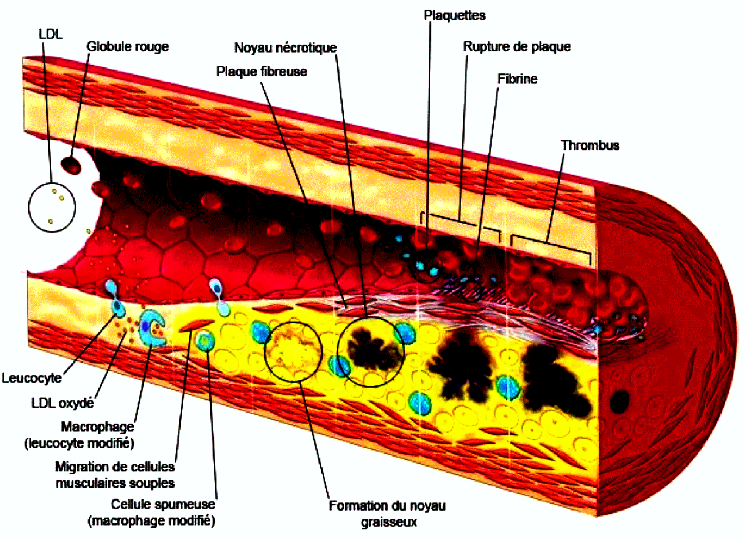 Dr RENUCCI - Athérosclérose