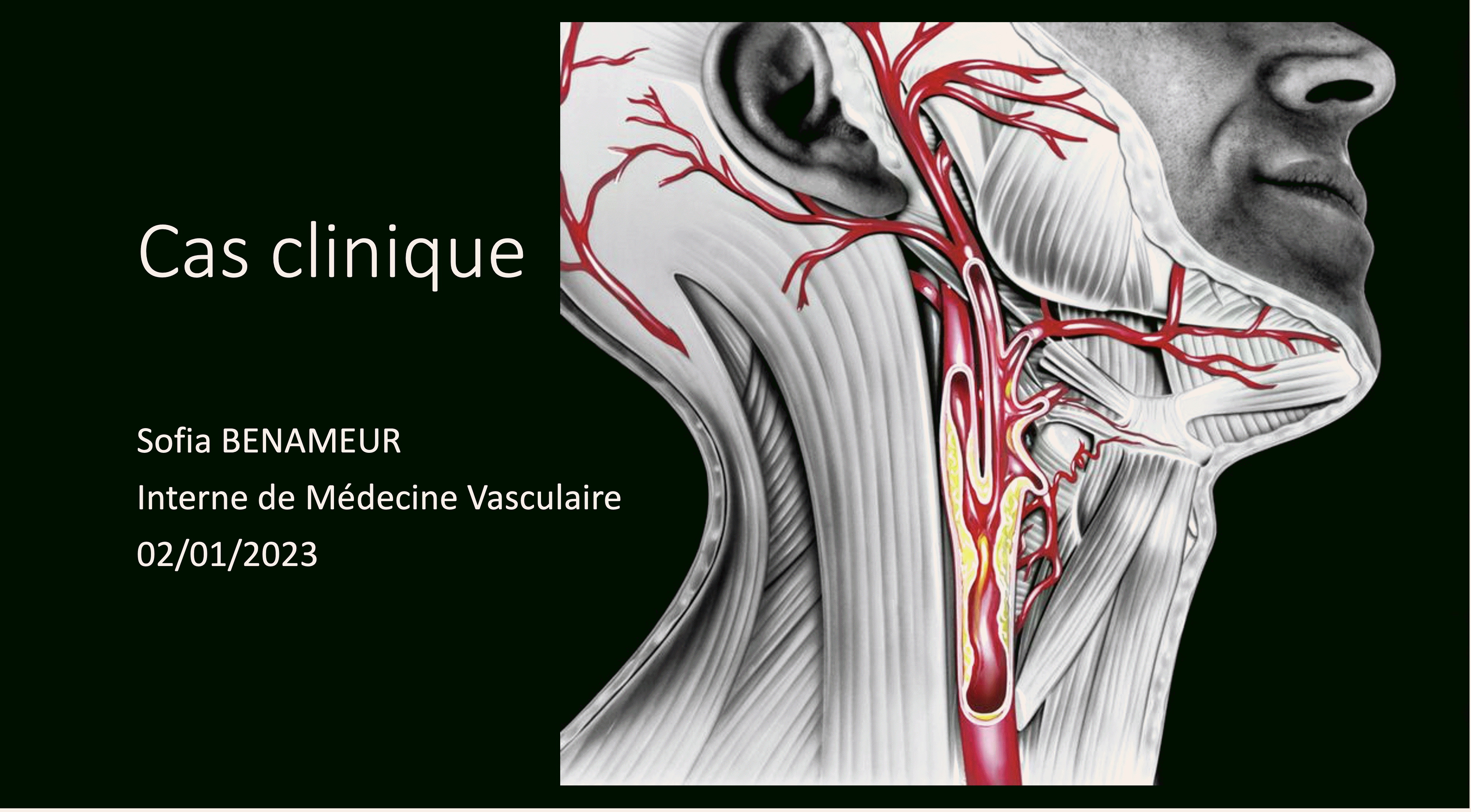 Sténose carotide - Médecine Vasculaire - Marseille