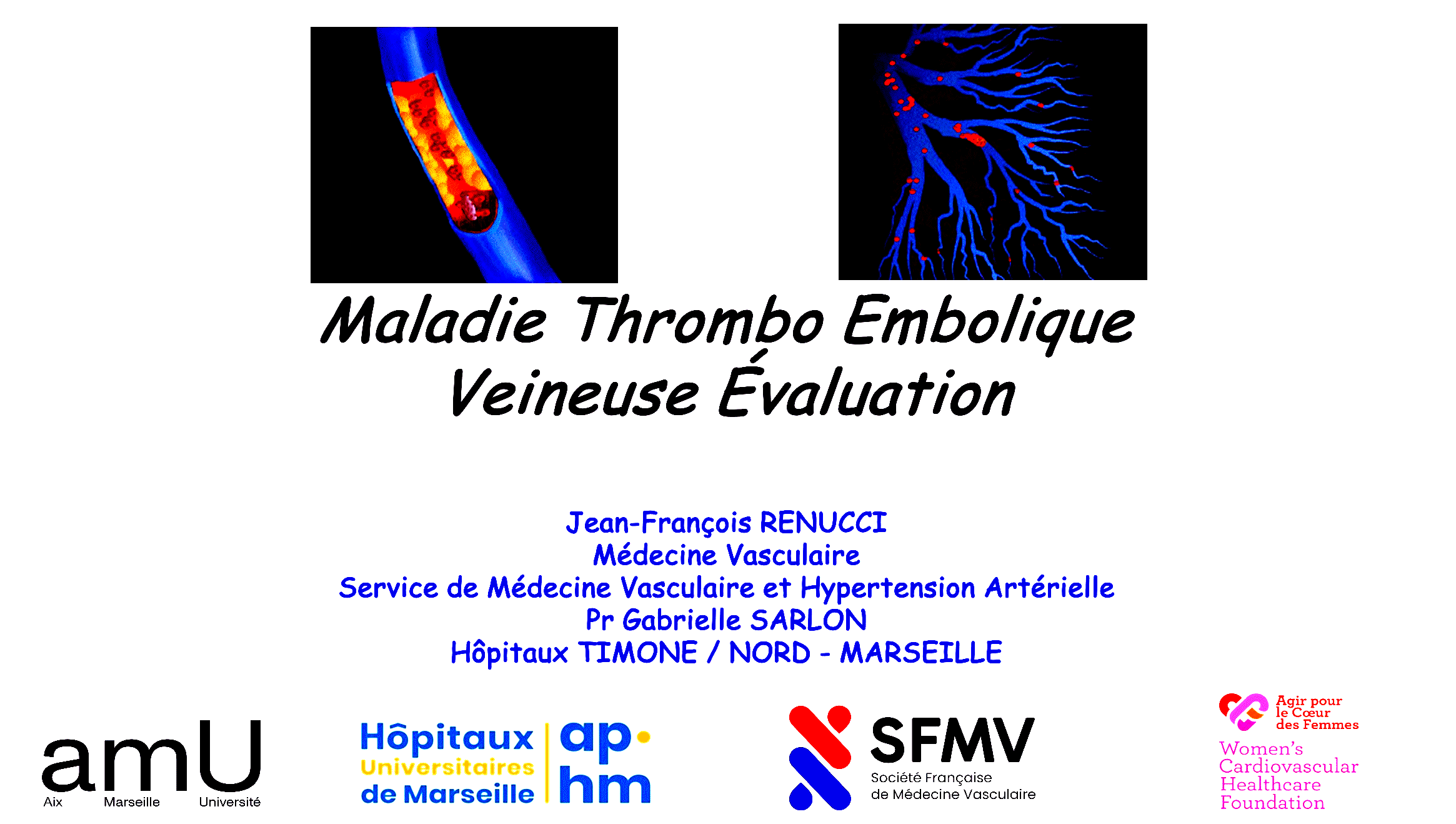 Dr RENUCCI - Maladie Thombo Embolique Veineuse MTEV Evaluation