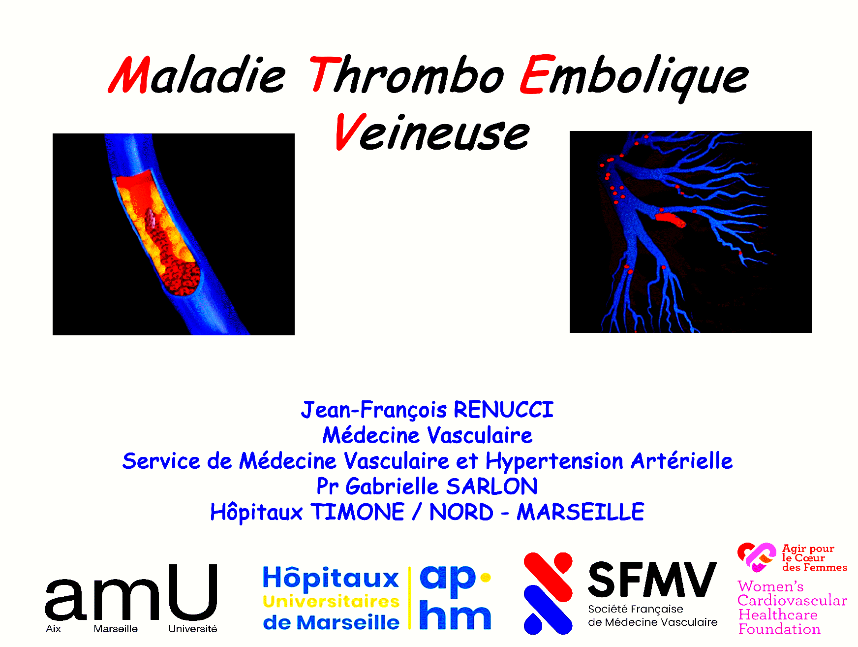 Dr RENUCCI - Maladie Thombo Embolique Veineuse MTEV